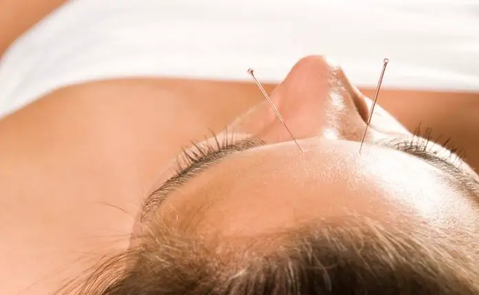 What Is Acupuncture And How It Works