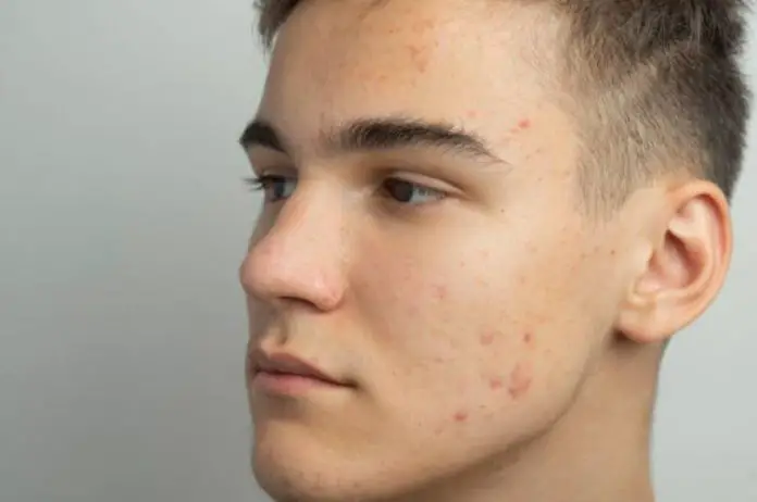 How To Find Effective Facial Treatments To Get Rid Of Acne