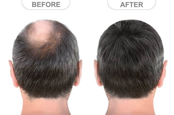 Home Remedies and Natural Hair Loss Treatments – How to Prevent and Stop Hair Loss Naturally and Effectively.