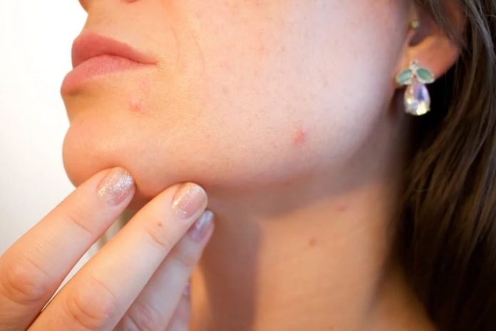 How Bacteria Can Cure Your Acne
