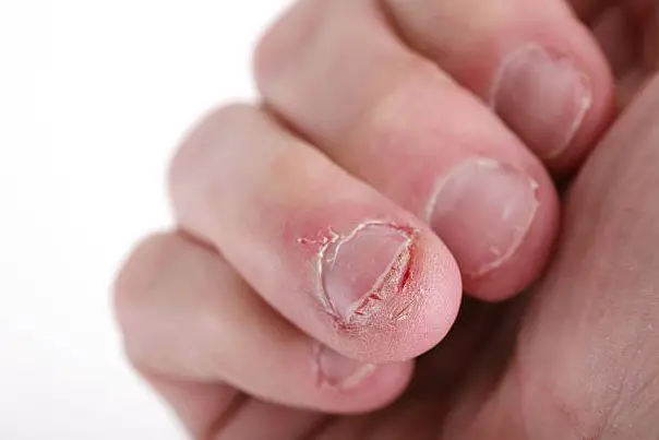 Nail Care Tips For Chronic Nail Biters