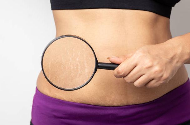 How To Get Rid Of Stretch Marks