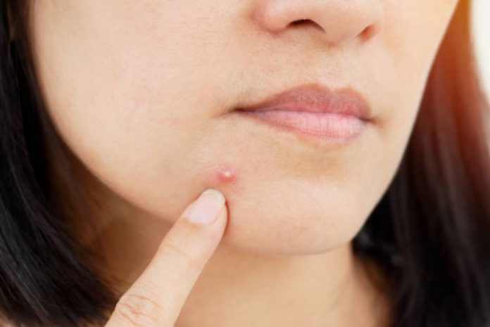 How To Get Rid Of Those Ugly Pimples For Good