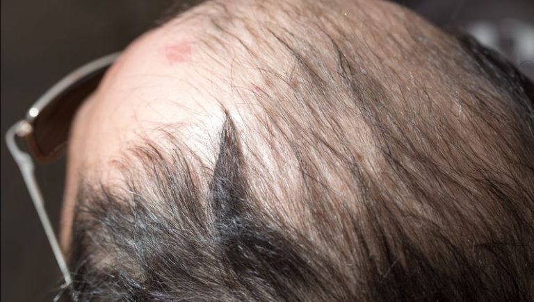 Best Vitamin And Mineral Supplements For Hair Loss