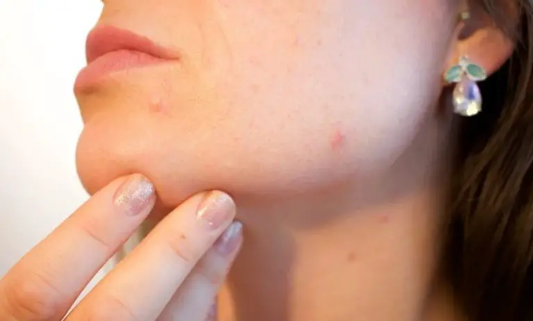 How To Get Rid Of Acne Spots Effectively And For Good In A Natural Way