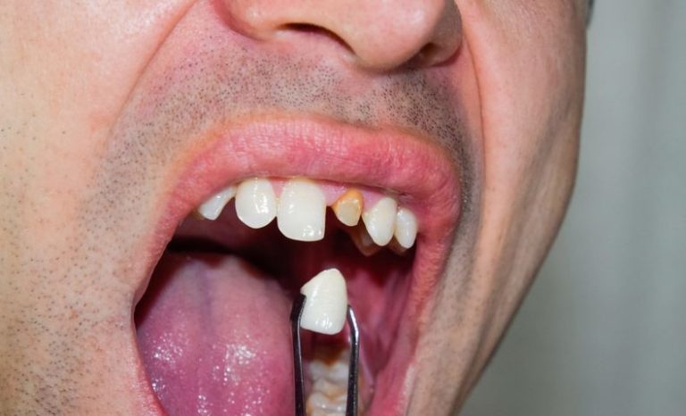 How To Recognize Tooth Enamel Loss