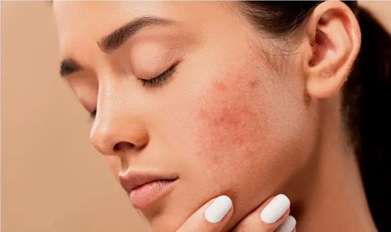 How To Clear Your Acne While You Sleep