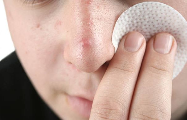 Boys and Puberty: 7 Tips On How To Deal With Acne