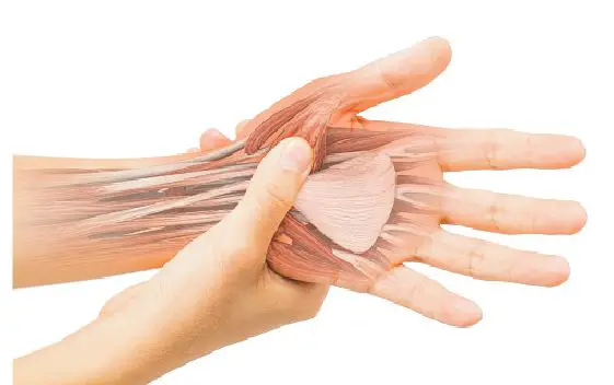 Carpal Tunnel Syndrome -- What Is It?
