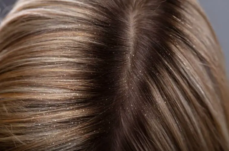 Disturbing Dandruff: How To Cope Up With The Problem?