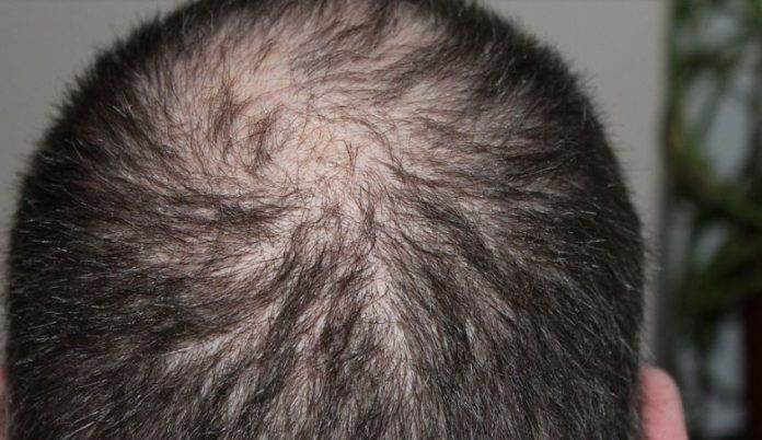 Laser Hair Loss Treatment