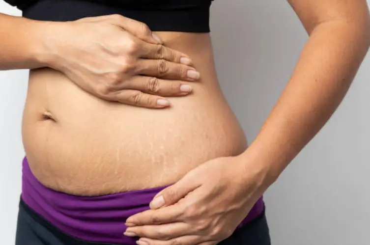 What To Do To Avoid Stretch Marks And How To Get Rid Of Them.