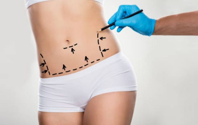 Tummy Tuck - FAQS