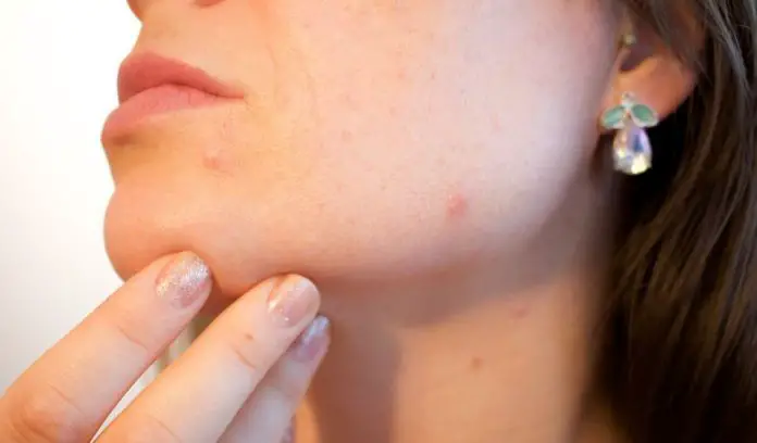 How To Get Rid Of Acne And Have Clear Skin Fast