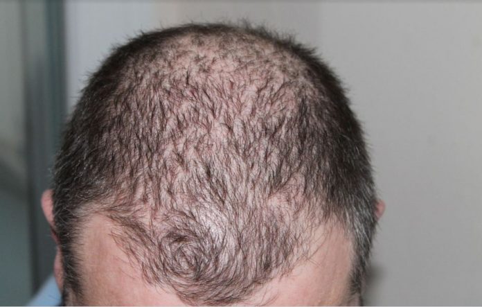 How To Stop Hair Loss And Prevent Hair Baldness