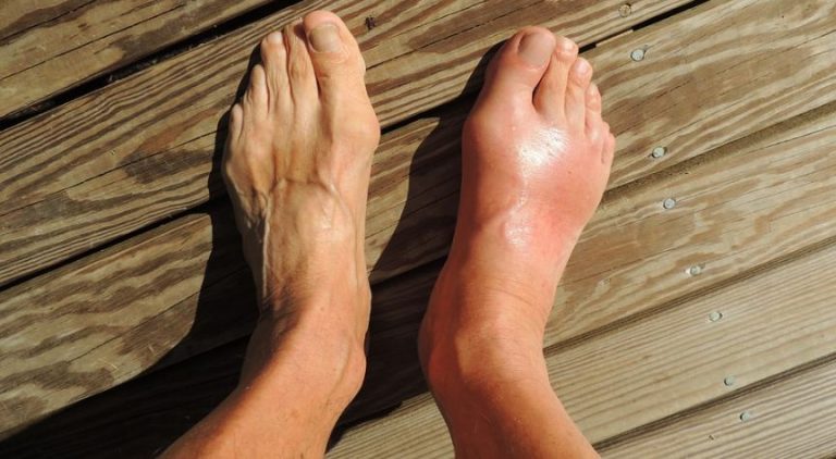 Signs Of Toenail Fungus