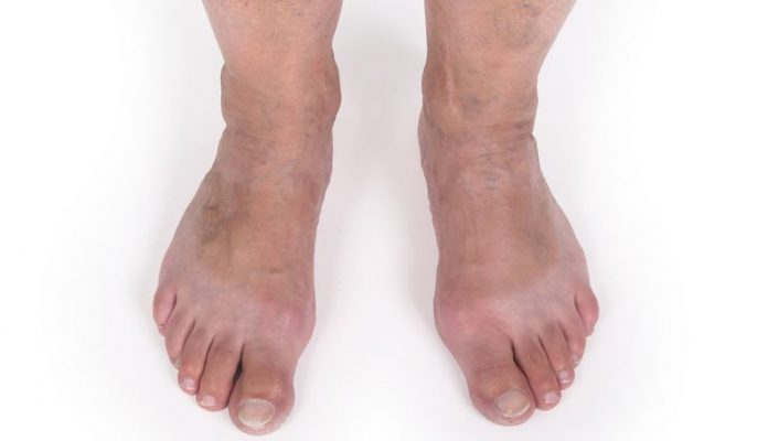 Get Rid Of Vexing Veins - Here Is How