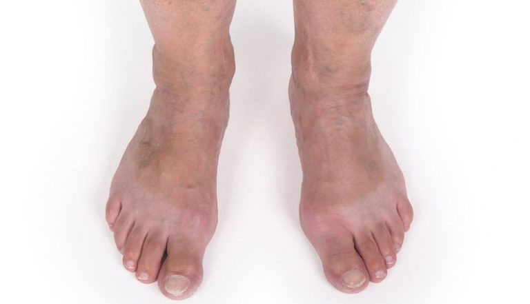 Get Rid Of Vexing Veins – Here Is How