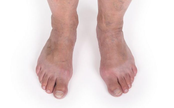 Got Varicose Vein Worries?