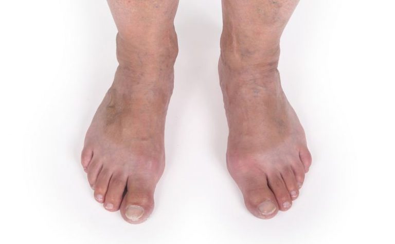 Got Varicose Vein Worries?